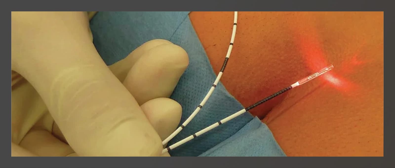 Procedimento de fístula anal com sonda a laser