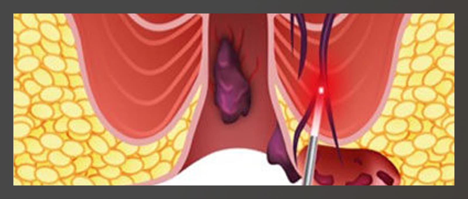 Ilustração anatômica do procedimento a laser para hemorroidas